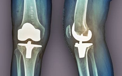 Total Knee Replacement